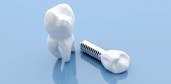 Professionelle Zahn Implantate